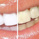 Warna Lipstik untuk Gigi Kuning