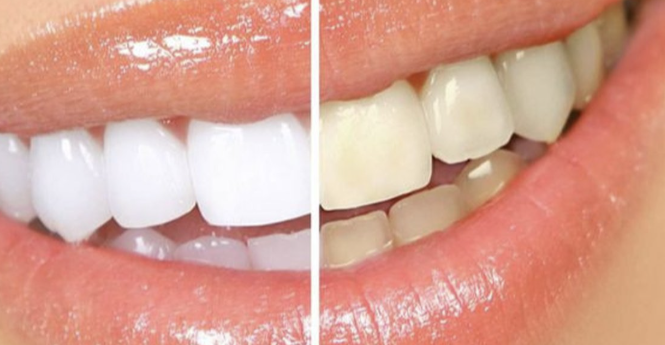 Warna Lipstik untuk Gigi Kuning